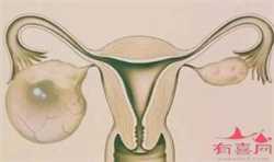 女人患4种疾病易发生宫外孕