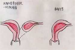 上海哪里招聘51宝贝助孕妈妈：有盆腔积液可以助孕吗